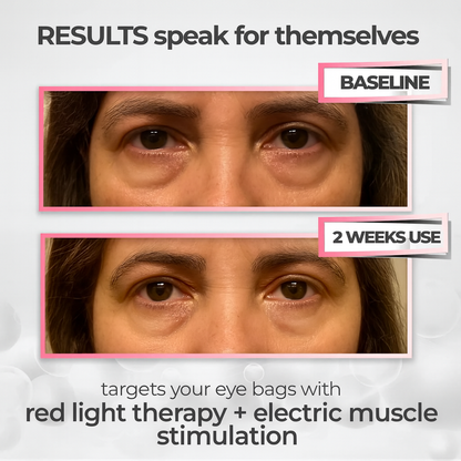EYENOVA™ Advanced Eye Bags Care Device